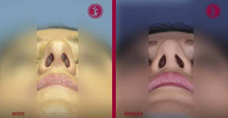 deformidad nasal en parentesis pre y post basal