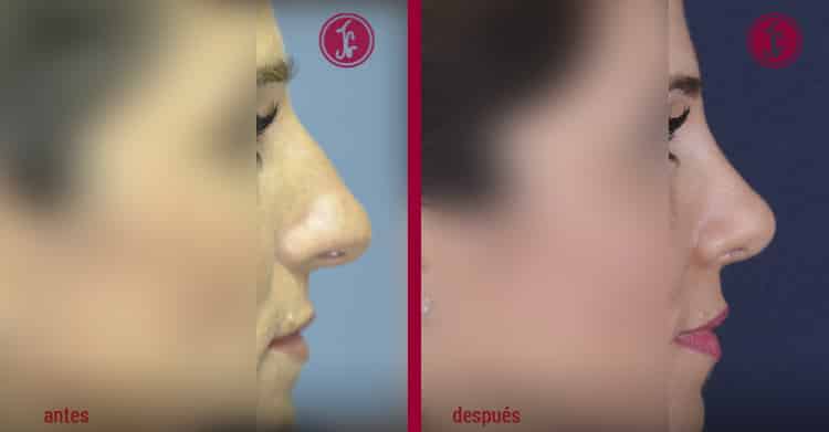 Deformidad nasal en paréntesis pre y post latera