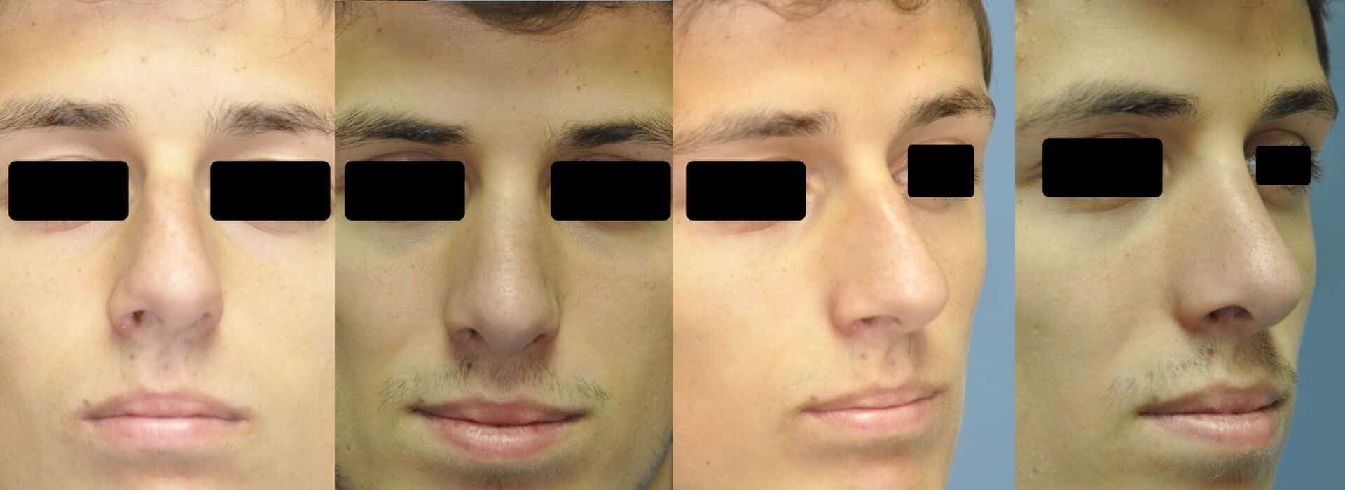 Antes y después de la rinoplastia en un hombre