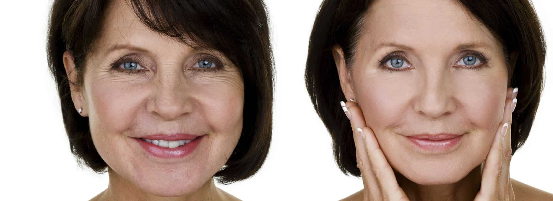 Cirugía antiaging o lifting cervicofacial ¿en qué consiste?