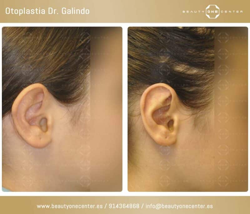 otoplastia u operación de orejas