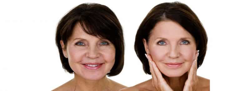 Antes y después de la lipoescultura facial