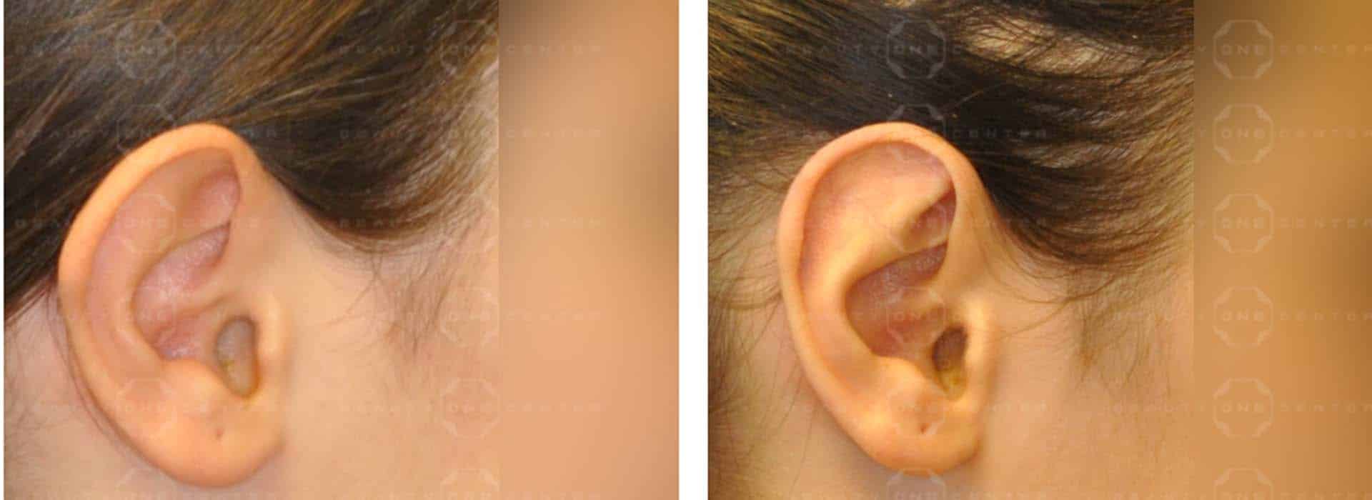 Operación de orejas antes y después