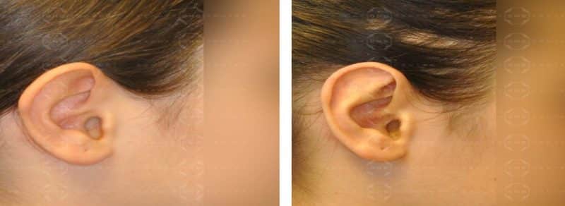 Postoperatorio de la otoplastia u operación de orejas
